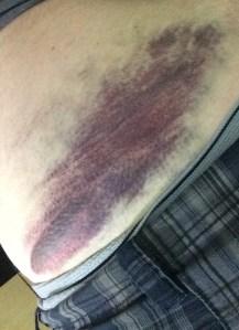 Ouch! Bruise from Rapids